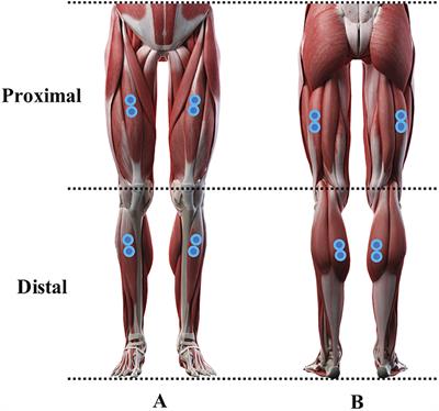 Abnormal Muscle Activity and Variability Before, During, and After the Occurrence of Freezing in Parkinson's Disease